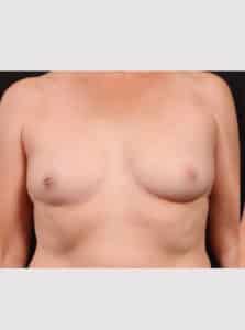 Inverted Nipple Repair