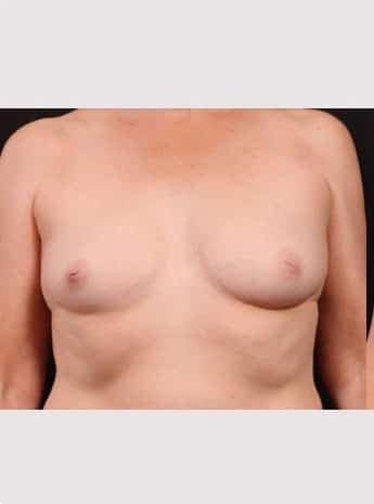 Before Image: Inverted Nipple Repair - front