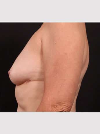 After Image: Inverted Nipple Repair - left-side