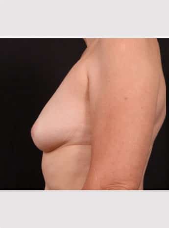 Before Image: Inverted Nipple Repair - left-side
