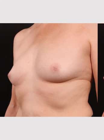 Before Image: Inverted Nipple Repair - left-front-oblique