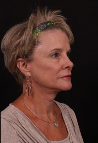 After Image: Full Face Lift - right-side