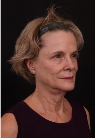 Before Image: Full Face Lift - right-side