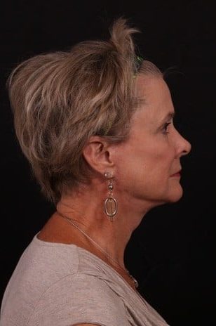 After Image: Full Face Lift - right-side