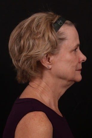 Before Image: Full Face Lift - right-side