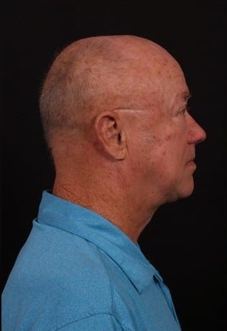 After Image: Neck Lift - right-side