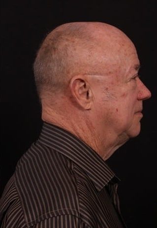 Before Image: Neck Lift - right-side