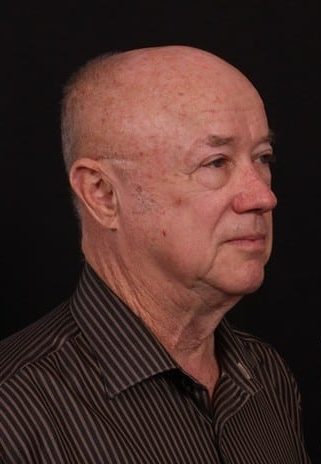 Before Image: Neck Lift - right-front-oblique