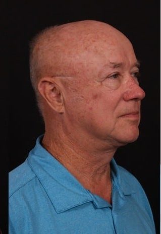 After Image: Neck Lift - right-front-oblique