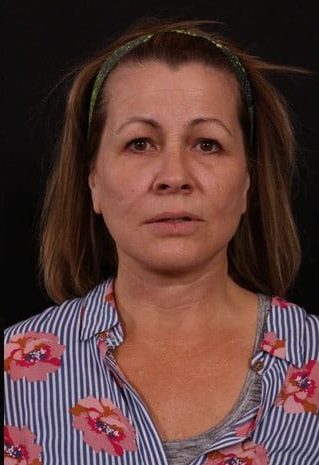 After Image: Neck Lift / Lower Facelift - front