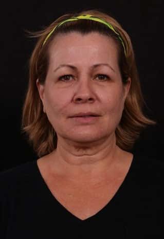 Before Image: Neck Lift / Lower Facelift - front