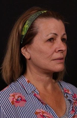 After Image: Neck Lift / Lower Facelift - right-front-oblique