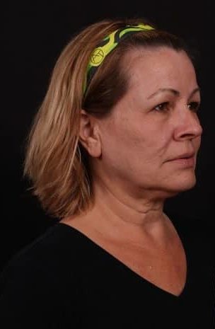 Before Image: Neck Lift / Lower Facelift - right-front-oblique