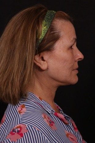 After Image: Neck Lift / Lower Facelift - right-side