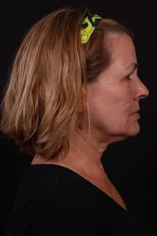 Before Image: Neck Lift / Lower Facelift - right-side