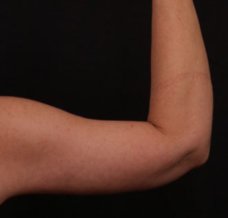 After Image: Brachioplasty (Arm Lift) - back
