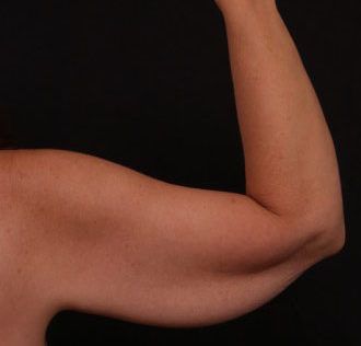 Before Image: Brachioplasty (Arm Lift) - back