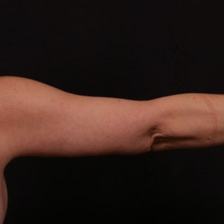 After Image: Brachioplasty (Arm Lift) - back