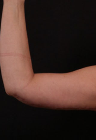After Image: Brachioplasty (Arm Lift) - front