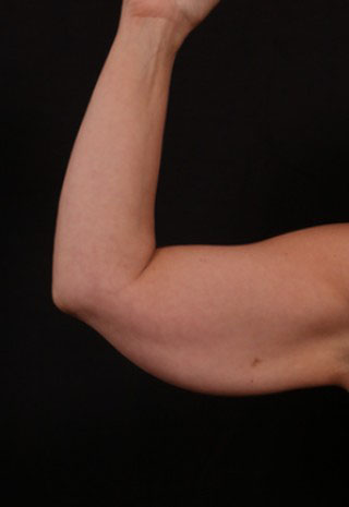 Before Image: Brachioplasty (Arm Lift) - front