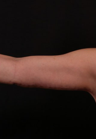 After Image: Brachioplasty (Arm Lift) - front