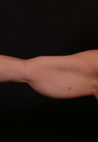 Before Image: Brachioplasty (Arm Lift) - front