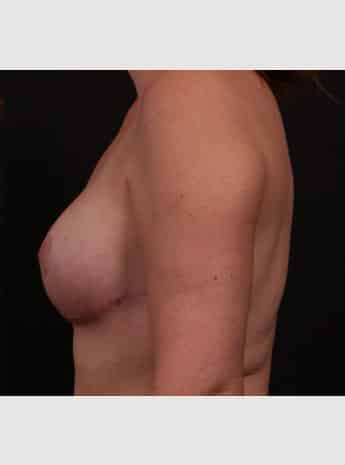 After Image: Mastopexy (Breast Lift) - left-side