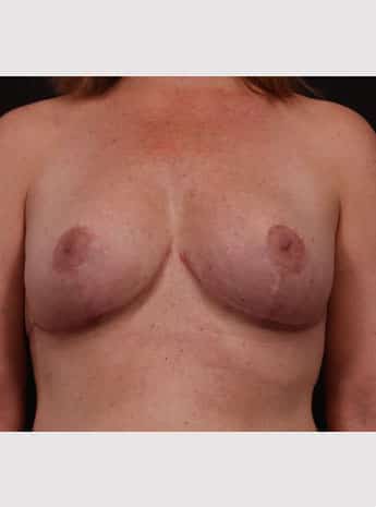 After Image: Mastopexy (Breast Lift) - front