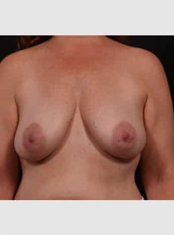 Before Image: Mastopexy (Breast Lift) - front
