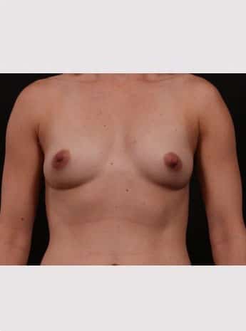 Before Image: Breast Augmentation - front