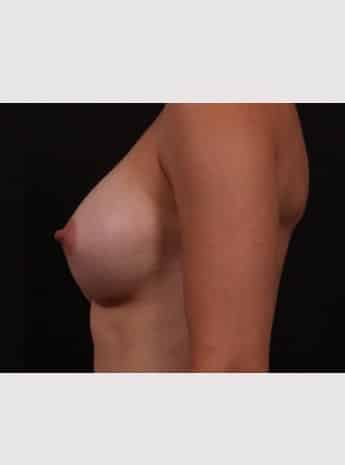 After Image: Breast Augmentation - left-side