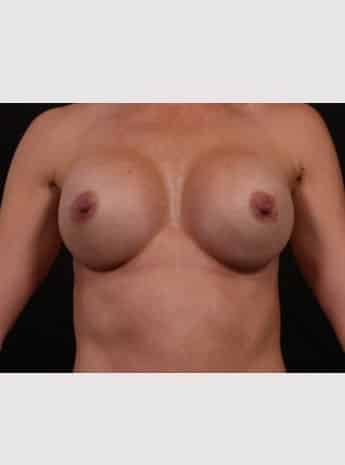 After Image: Primary Breast Augmentation - front