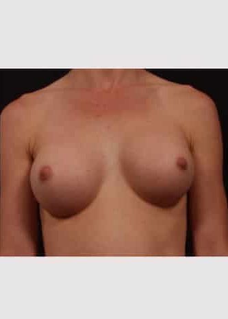 After Image: Breast Augmentation - front