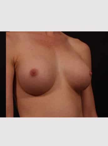 After Image: Breast Augmentation - right-front-oblique