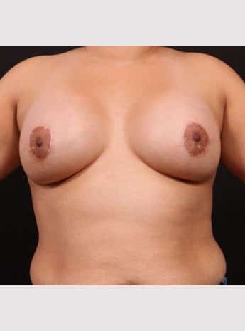 After Image: Breast Augmentation with Peri Areolar Lift - front