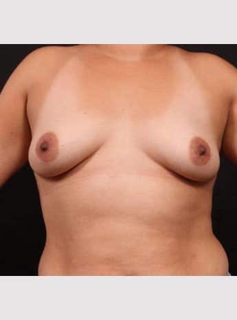 Before Image: Breast Augmentation with Peri Areolar Lift - front