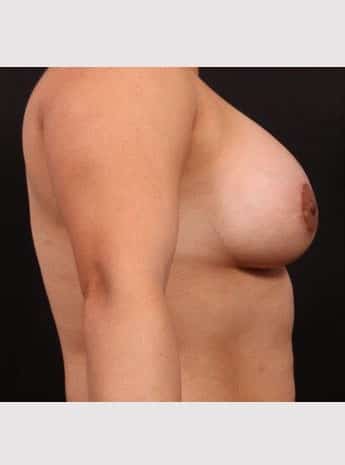After Image: Breast Augmentation with Peri Areolar Lift - right-side