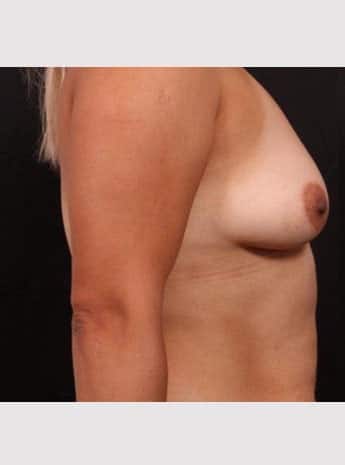 Before Image: Breast Augmentation with Peri Areolar Lift - right-side