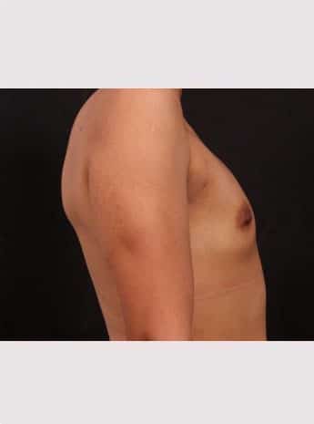 Before Image: Breast Augmentation - right-side