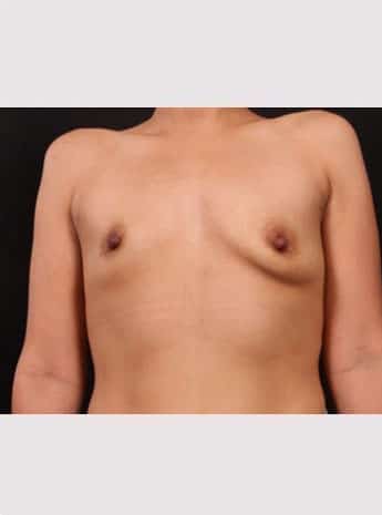 Before Image: Breast Augmentation - front