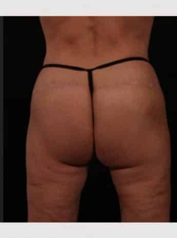 After Image: Butt Lift with Fat Grafting - back