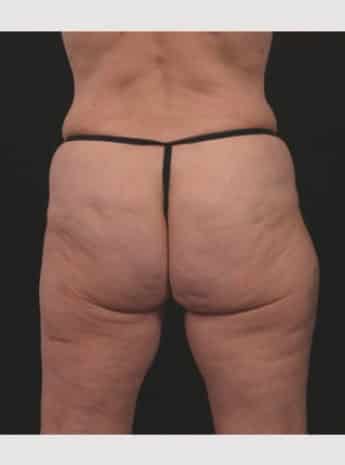 Butt Lift with Fat Grafting