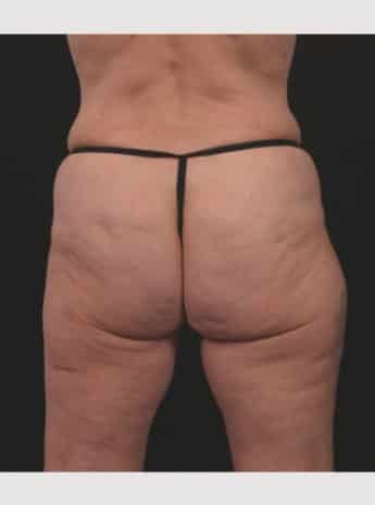 Before Image: Butt Lift with Fat Grafting - back