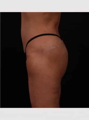 After Image: Butt Lift with Fat Grafting - left-side