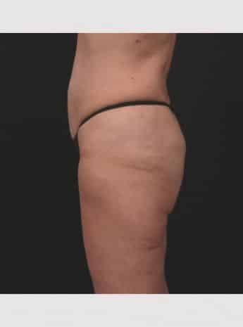 Before Image: Butt Lift with Fat Grafting - left-side