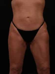 After Image: Inner and Outer Thigh Lift