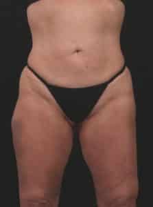 Before Image: Inner and Outer Thigh Lift