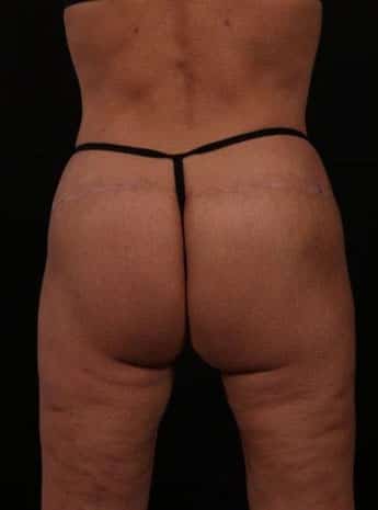 After Image: Inner and Outer Thigh Lift - back