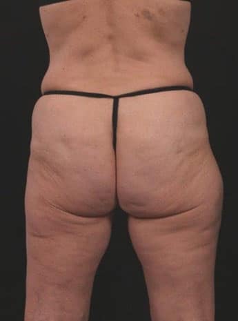 Before Image: Inner and Outer Thigh Lift - back
