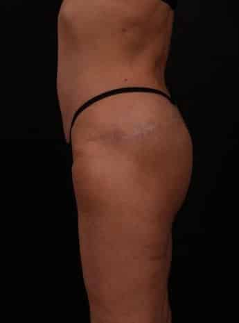 After Image: Inner and Outer Thigh Lift - left-side